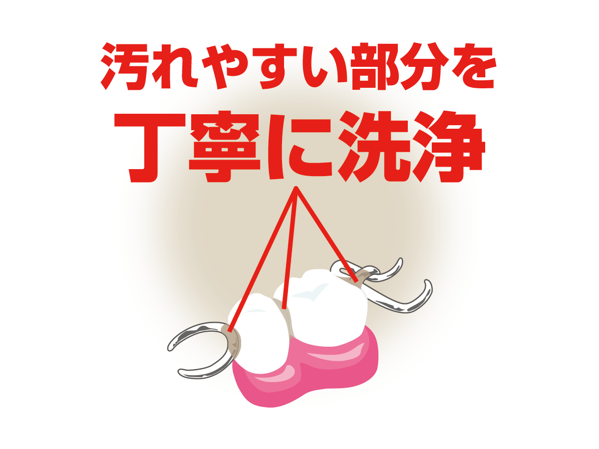 部分入れ歯はバネの部分やその付け根まで丁寧に洗浄